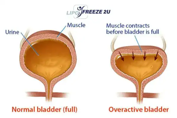 diagram of overactive bladder treatment Ascot