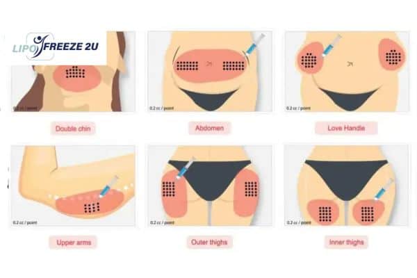 Benefits of Choosing Aqualyx for Fat Reduction Ascot