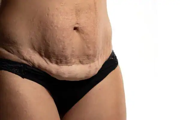 loose skin after weight loss injections Ascot