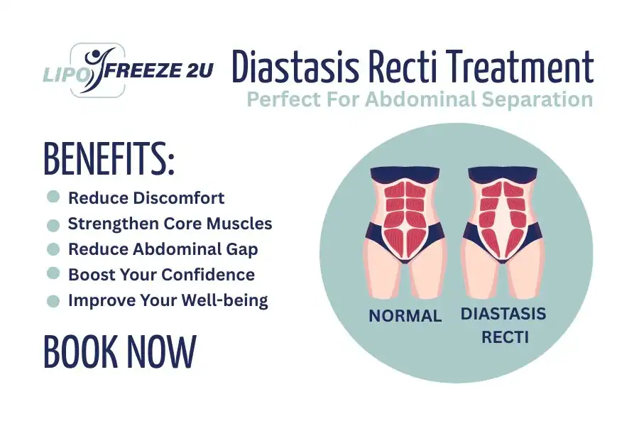 Benefits of body toning treatment Ascot for Diastasis recti
