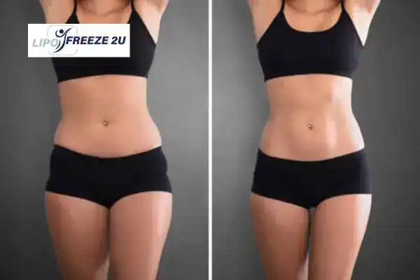 How Can LIPO FREEZE 2U Support Your Post-Pregnancy Body Recovery Ascot?