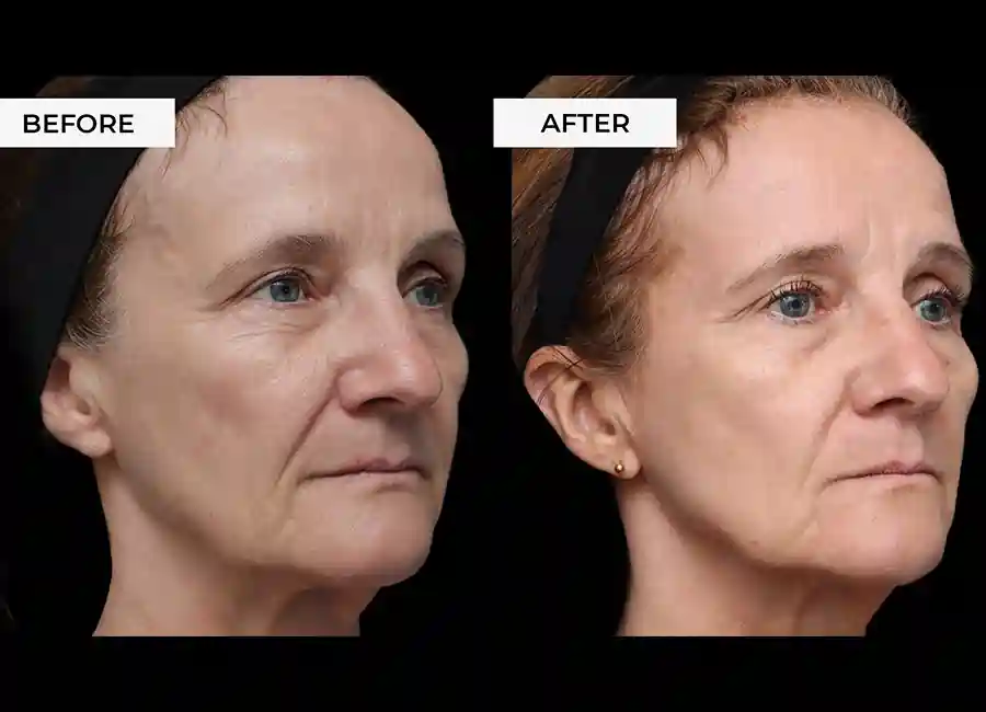 How Many RF Microneedling Sessions Will You Need to See a Difference Ascot?