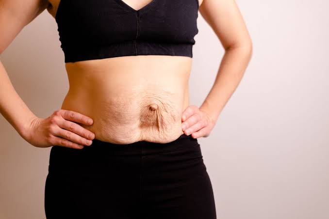 Is Surgery Really the Only Way to Repair Diastasis Recti Ascot?