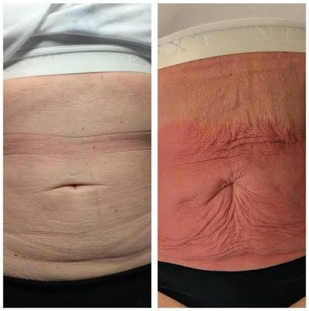 How Does RF Microneedling Improve Crepey, Thin and Uneven Skin Texture Ascot?