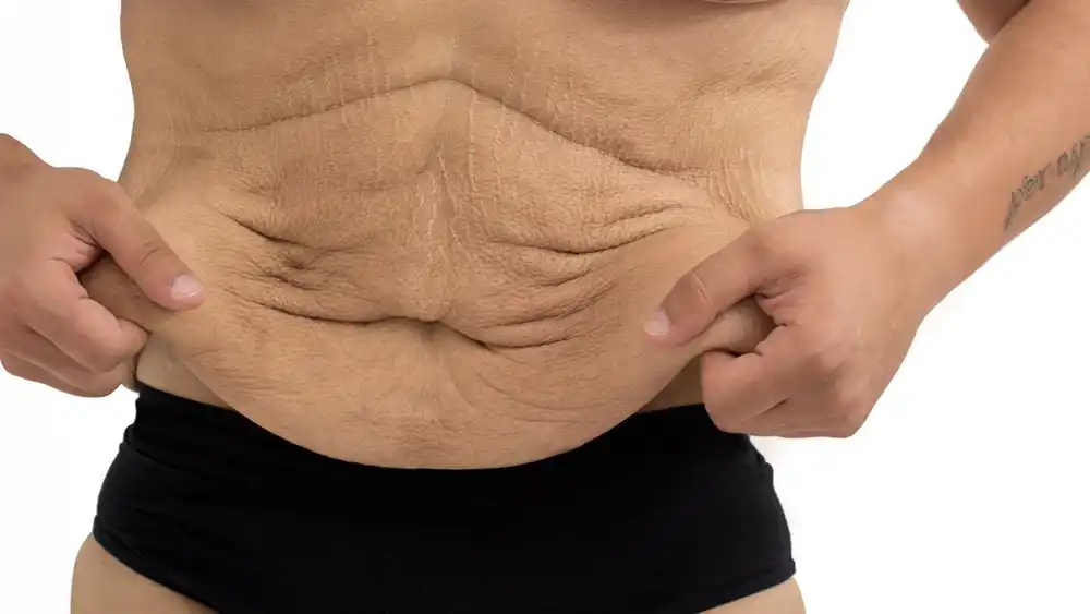 Why Does Weight Loss Medication Leave Some People With Loose or Sagging Skin Ascot?